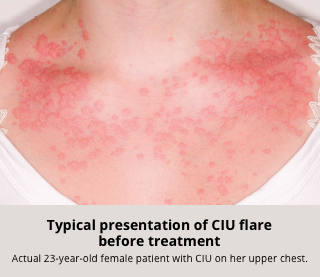 Typical CIU Flare Before XOLAIR Treatment