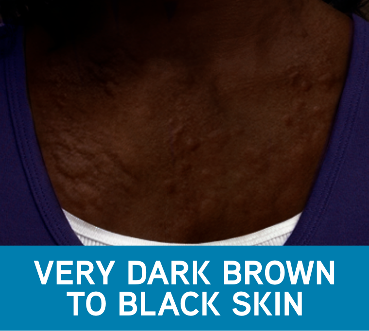 CSU Treatment Guidelines | XOLAIR® (omalizumab) | HCP