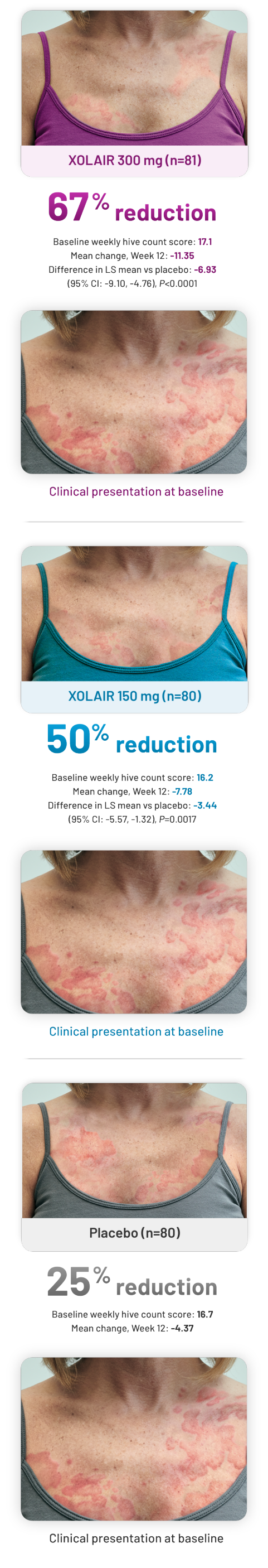 Chronic Spontaneous Urticaria (CSU) Treatment Clinical Trial